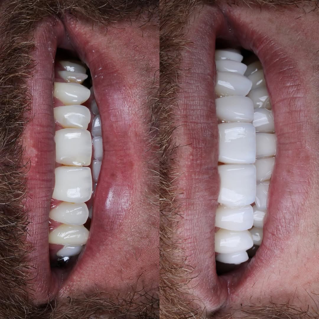 Antes e depois — caso 3